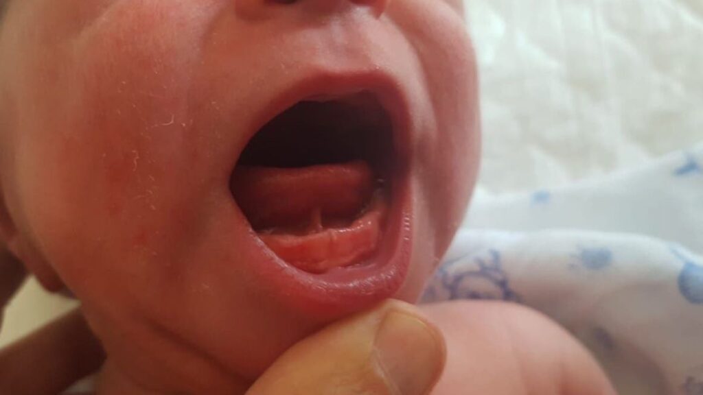 Frenillo Sublingual Bebe