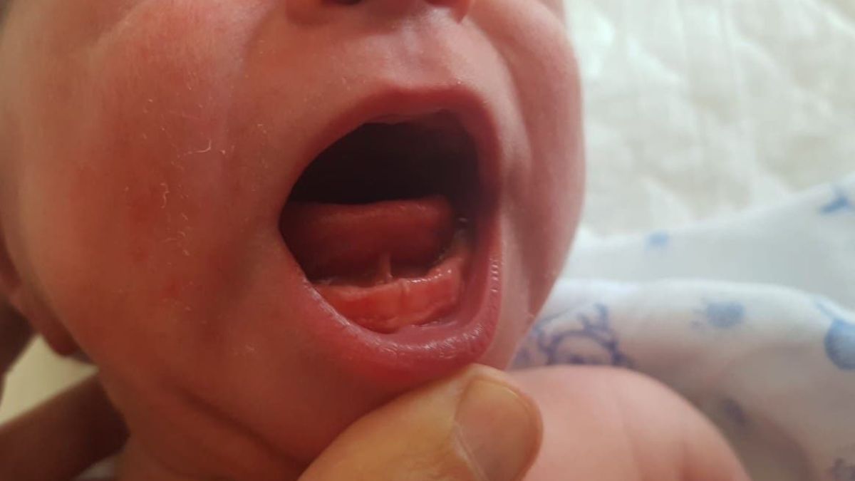 Frenillo Sublingual Bebe