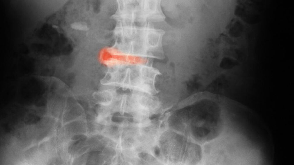 Espondilitis anquilosante